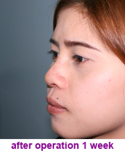 plastic_surgery_augmentation_rhinoplasty